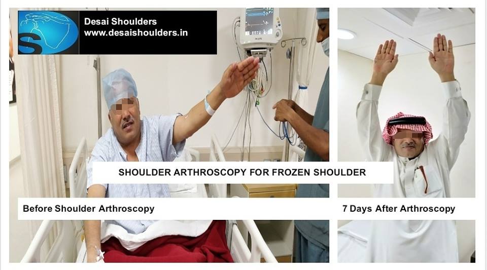 Perfect result after shoulder arthroscopy by Dr. Chintan Desai - Best Orthopaedic Shoulder Surgeon Mumbai